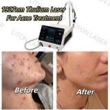 1927nm Thulium Laser + 1550nm Erbium Laser Double Wavelength Skin Beauty Equipment